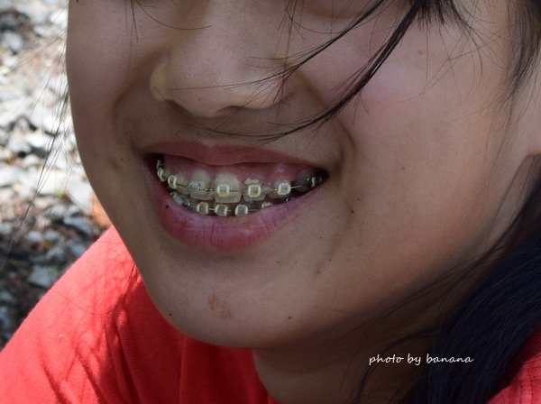 永久歯欠損　先天的に永久歯が無い　矯正