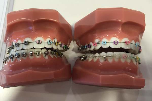 永久歯が無い　先天性欠損歯の矯正ブログ